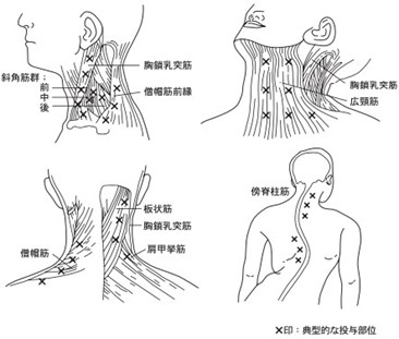 ボトックス画像5